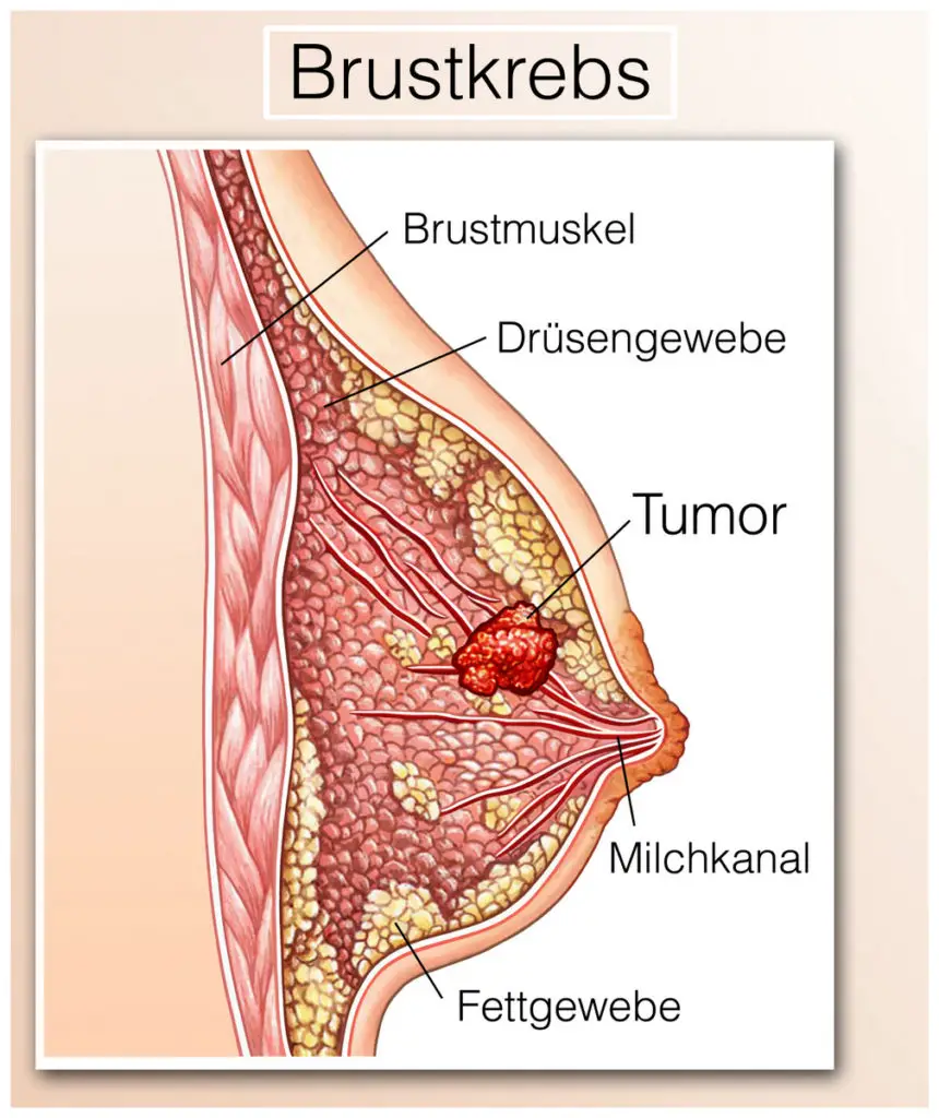 Angst vor Mammographie Ergebnis - Brustkrebs (© Henrie / Fotolia)